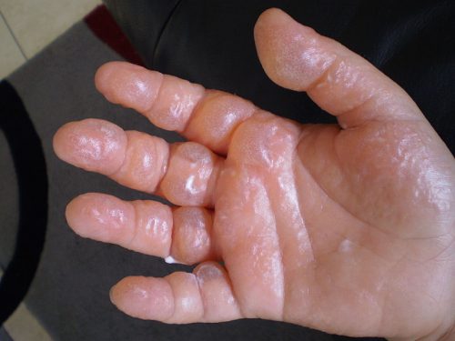 800px Phytophotodermatitis Severe Case
